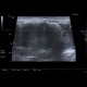 Abscess of thigh, perianal abscess: US - Ultrasound